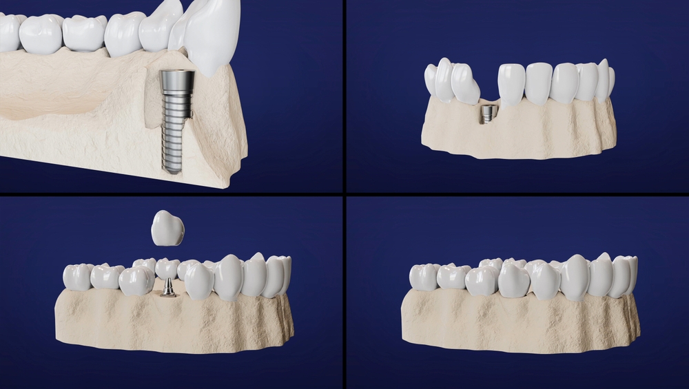 Step by step how a dental implant is applied and how a bone graft is applied.